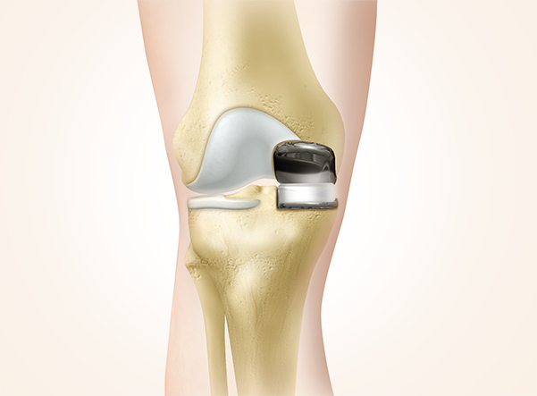 Partial-Knee-Replacement