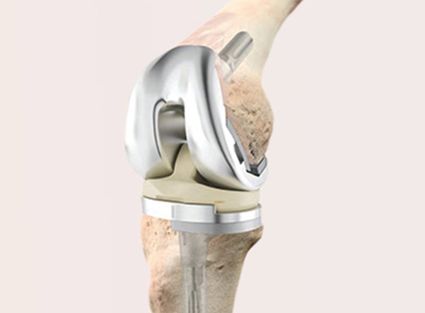 revision-knee-replacement